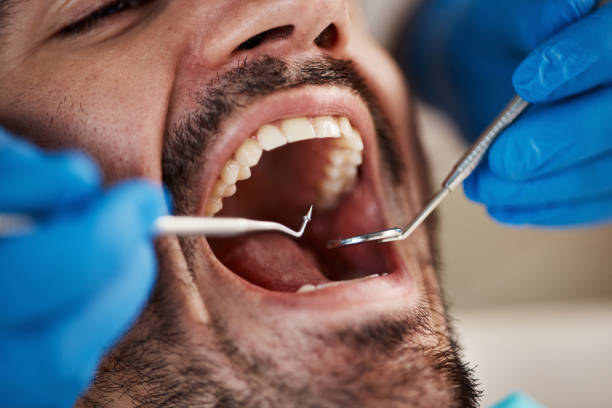 Best Dental Fillings (Composite and Amalgam)  in Lebanon, IN